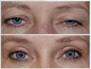 ptosis surgery in turkey