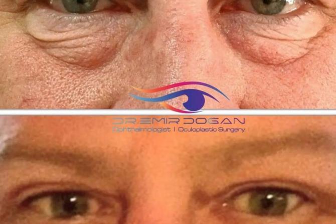 Erwägen Sie eine Blepharoplastik in Antalya, Türkei