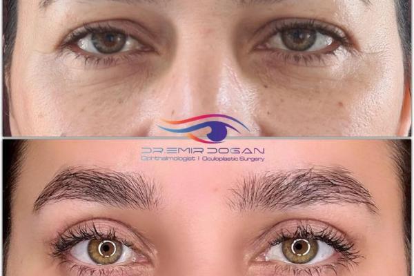 Blépharoplastie Turquie chirurgie paupiere
