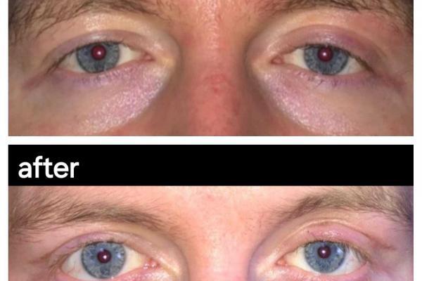 Eye Surgery Antalya Turkey